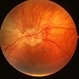 Central areolar choroidal dystrophy